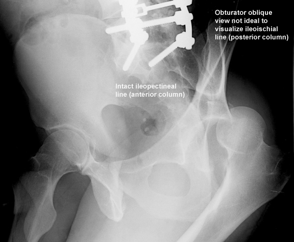 acetabular-fractures-trauma-orthobullets